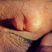 Oculoplastic & Oncology